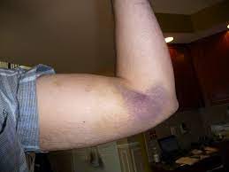 Bowling Injuries Upper Arm