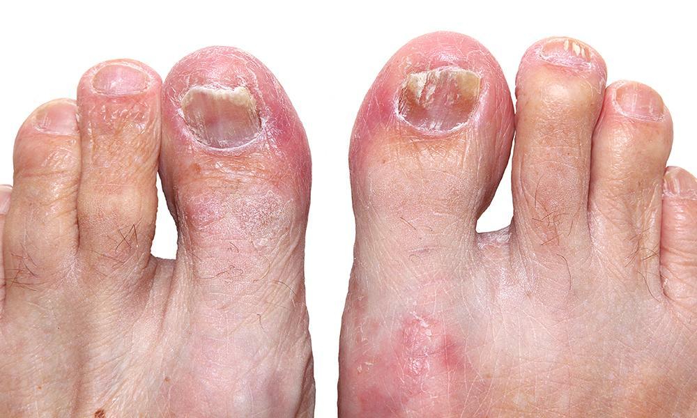 Can You Get Toenail Fungus From Bowling Shoes?